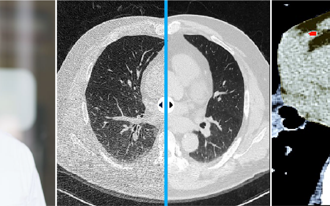 How AI-based CT Denoising Impacts Imaging Workflow Efficiency: An Experience at Tuebingen University