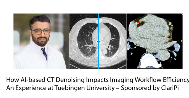 How AI-based CT Denoising Impacts Imaging Workflow Efficiency: An Experience at Tuebingen University