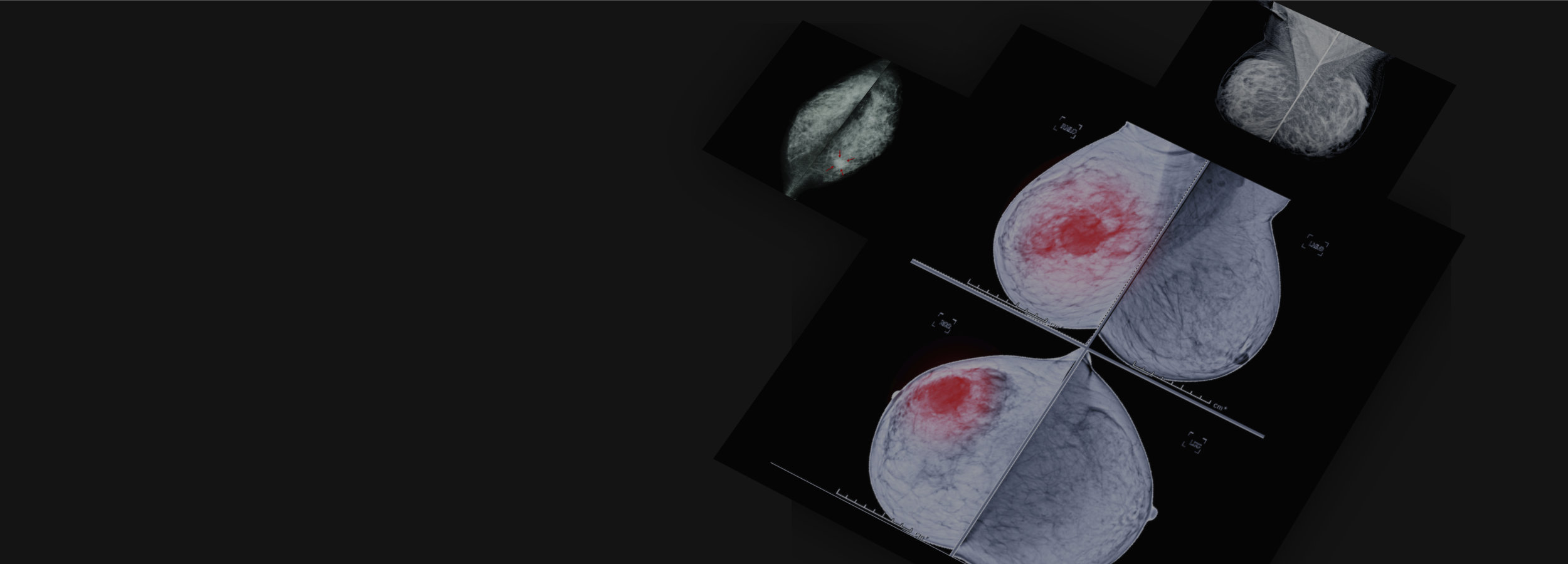 Breast imaging basics ESR Connect